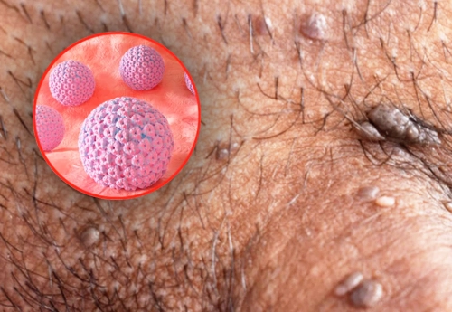 Erkekler HPV (Genital Siğil) İçin Hangi Doktora Gitmeli?